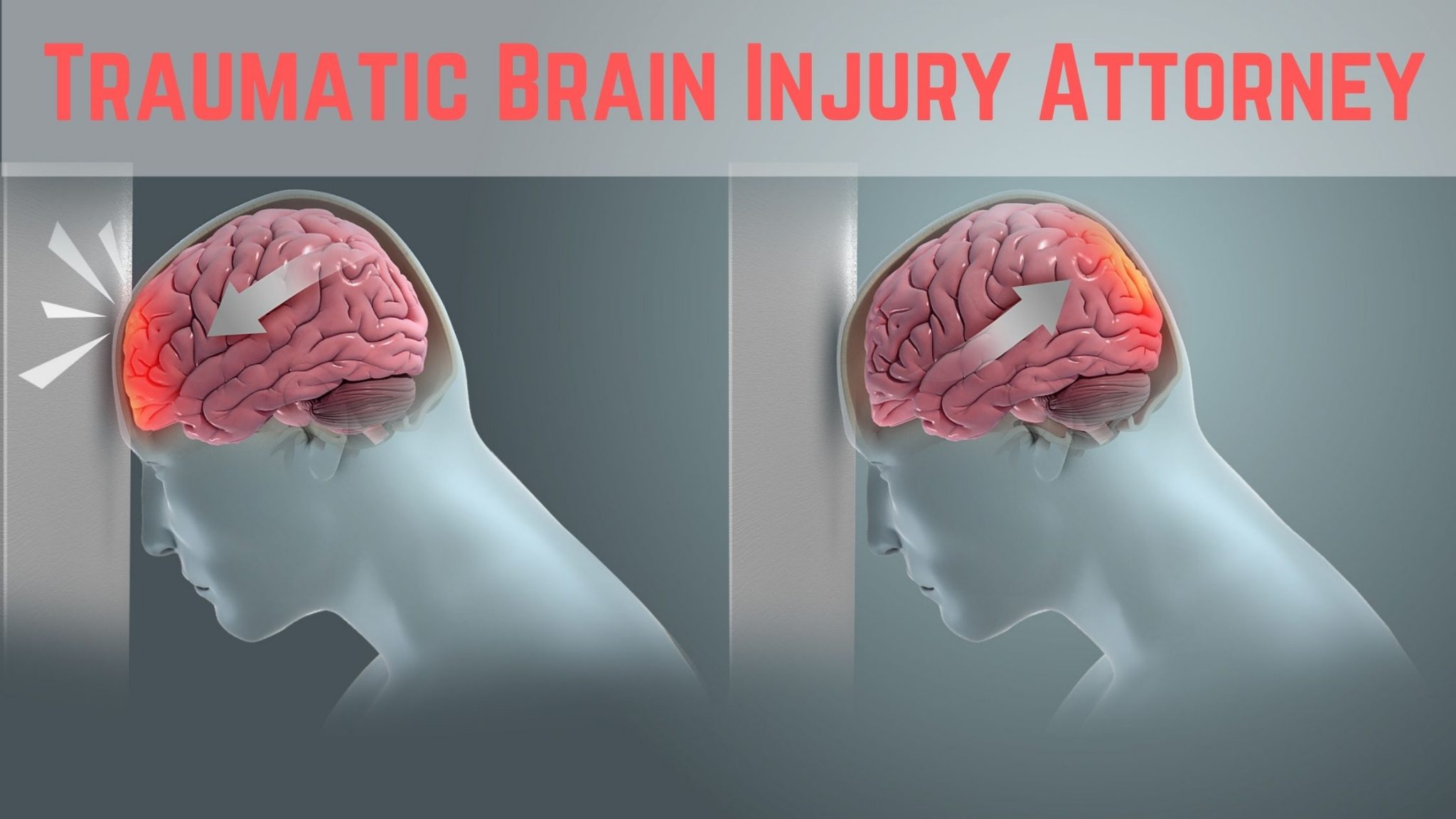 Coup injury brain contrecoup traumatic injuries sand llc law strikes involving refer variety head