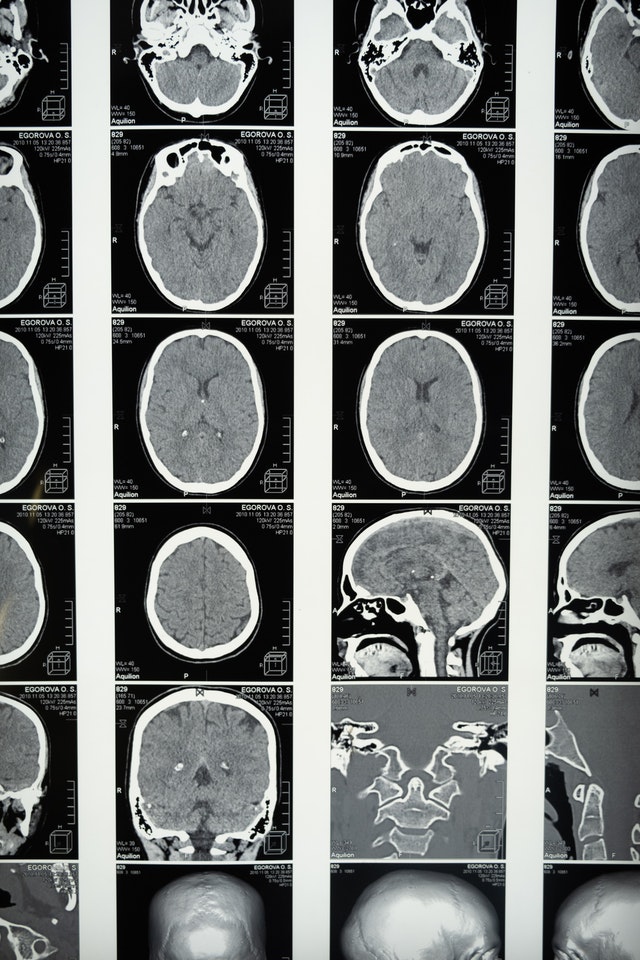 Workers Comp Brain Injury